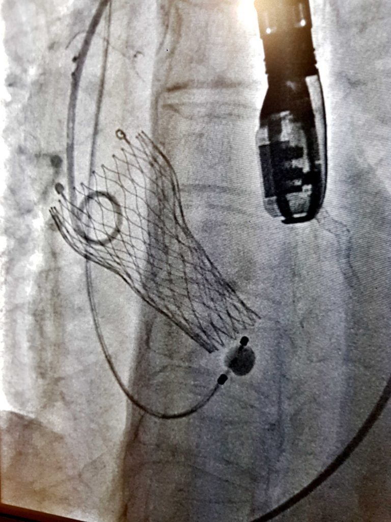 KIMS Doctors Replace Valve Without Open Heart Surgery