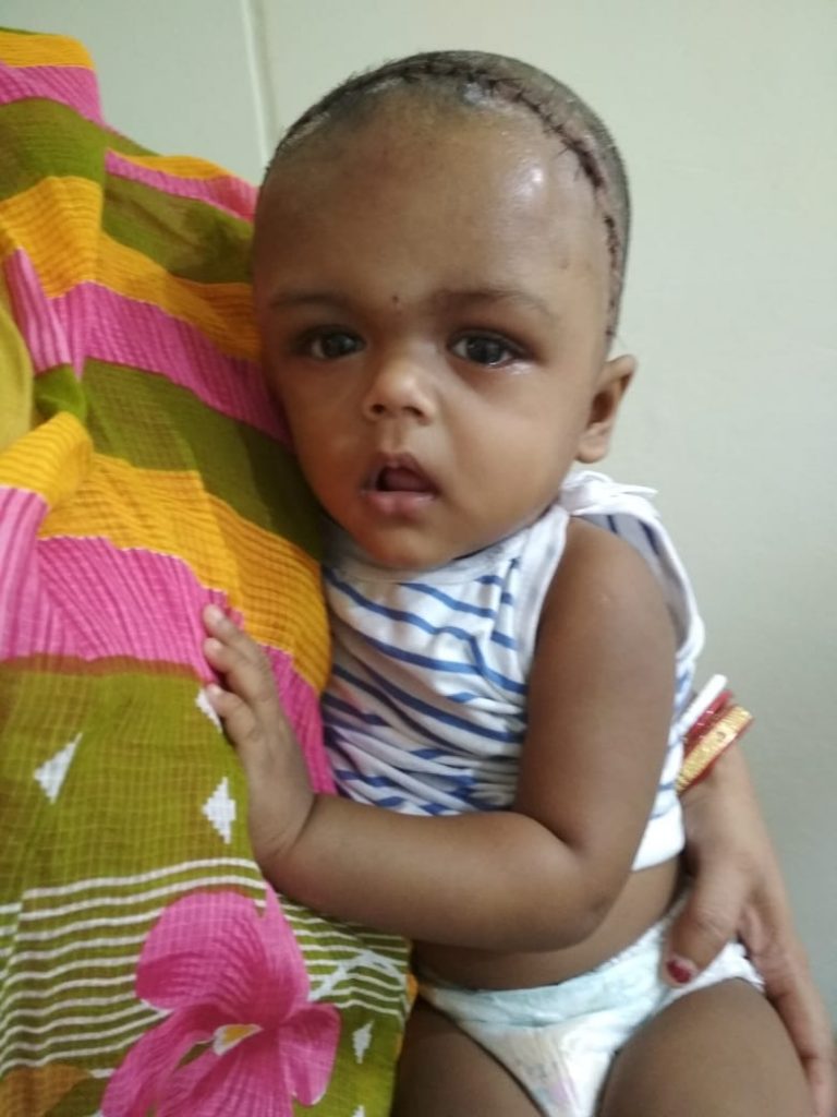 Prof Ashok Mohapatra Conducts Rare Skull Surgery At SUM Hospital