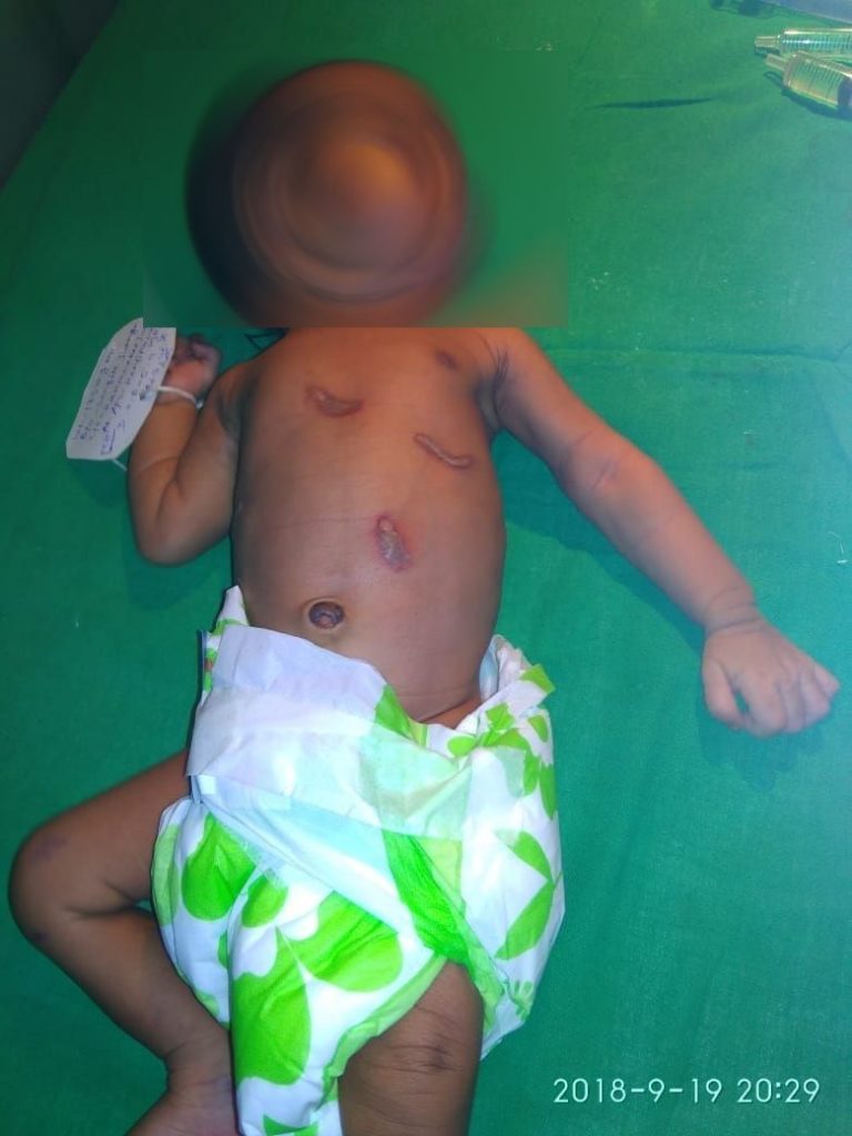 Newborn Branded With Hot Iron In Keonjhar