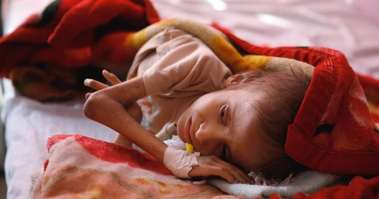 Yemen malnutrition