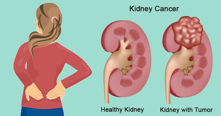 Kidney Cancer Awareness Month: Know All About The Disease