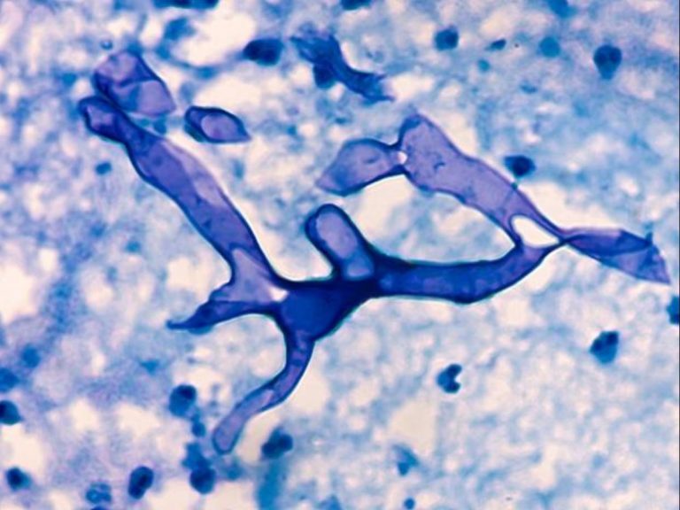 4 Black Fungus Deaths In Odisha