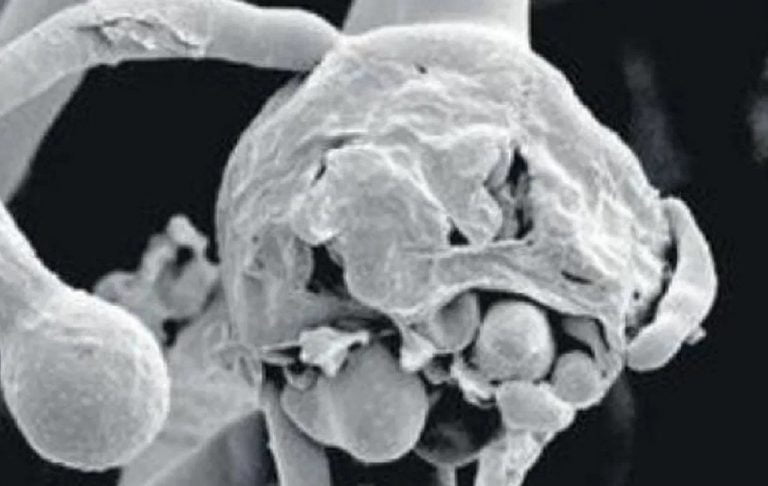 Doctors Find White Fungus Abscess In Recovered COVID-19 Patient’s Brain