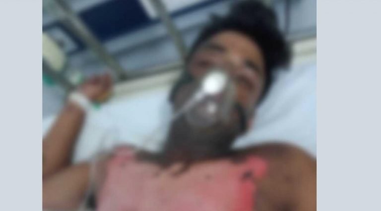 17-Yr-Old Suffers Major Burns Due To Alleged Negligence Of TPWODL; Pleas For Compensation Ignored