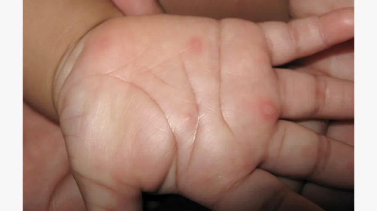 Is Tomato Fever Just Another Name For Hand, Foot & Mouth Disease?