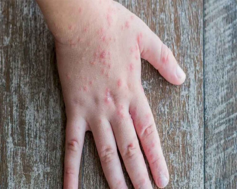 tomato flu spreading in India