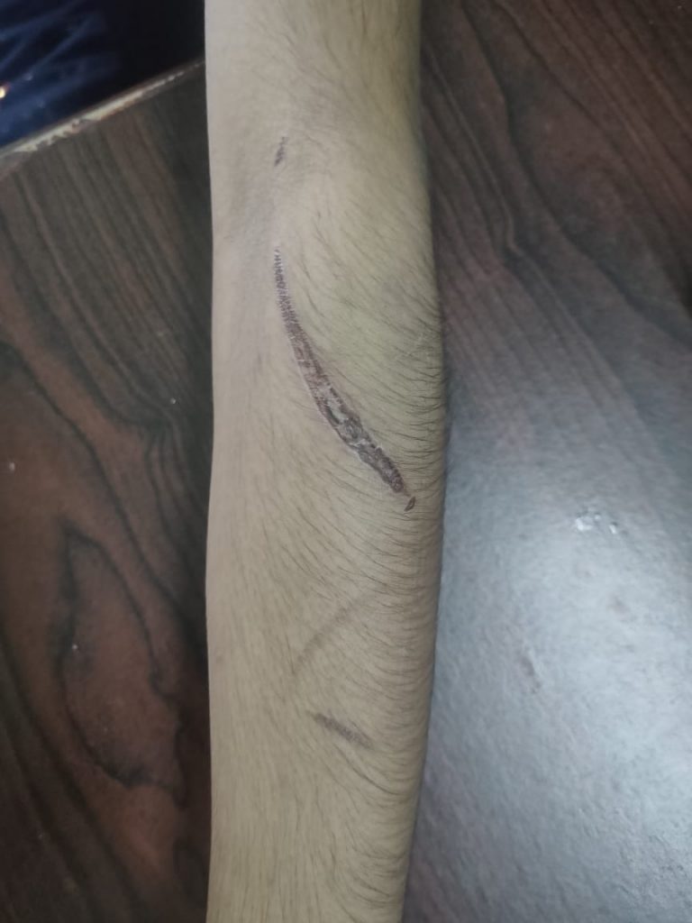 Minor Girl Rescued After Torture By Employer In Odisha Capital