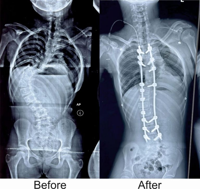 KIMS rare spine surgery