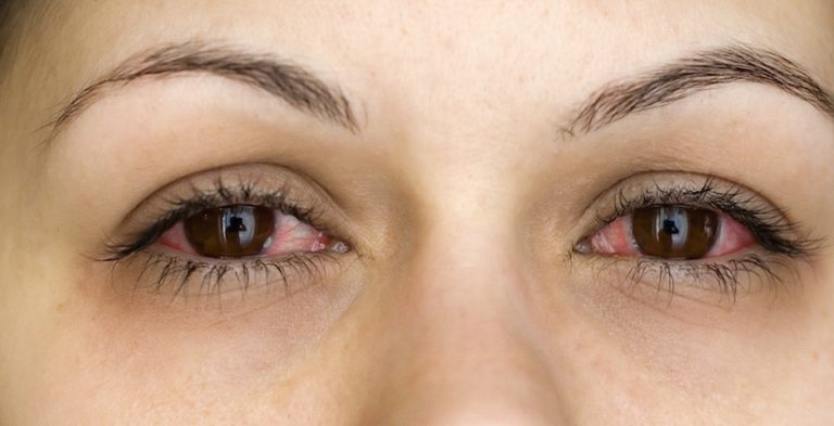 conjuctivitis
