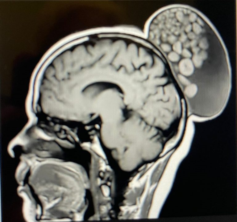 What Is Cystic Teratoma, Appearing Like A Sack Of Marbles Growing On Woman’s Scalp Removed By Doctors?