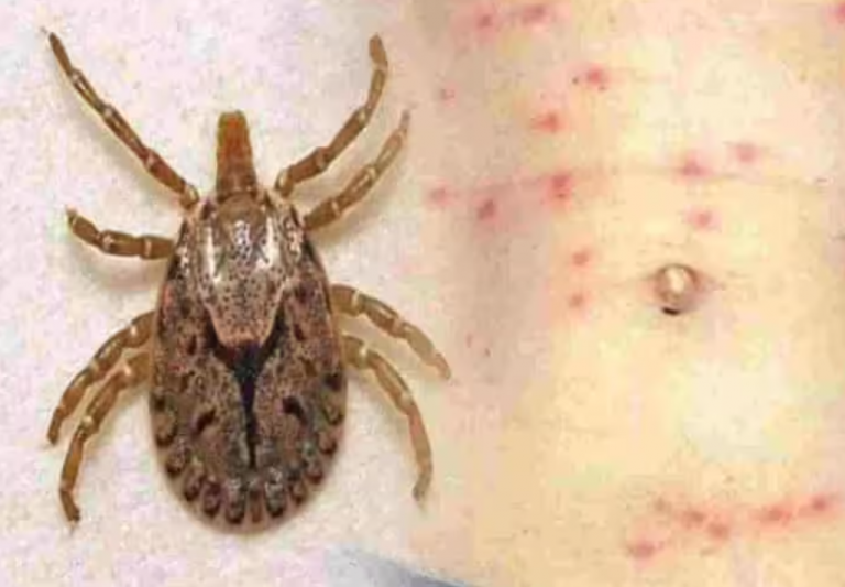 13 New Scrub Typhus Cases Detected In Odisha’s Sundargarh; Total Patients 263