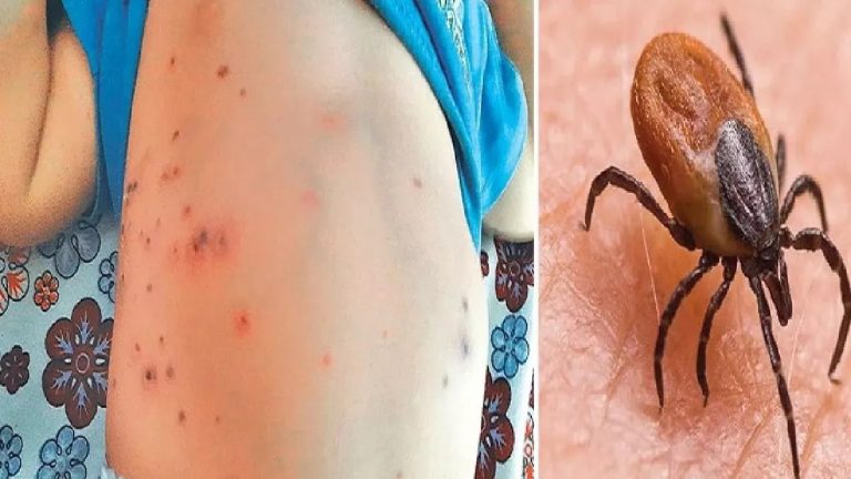 Scrub Typhus Cases Touch 183 In Odisha’s Sundargarh With 3 New Patients