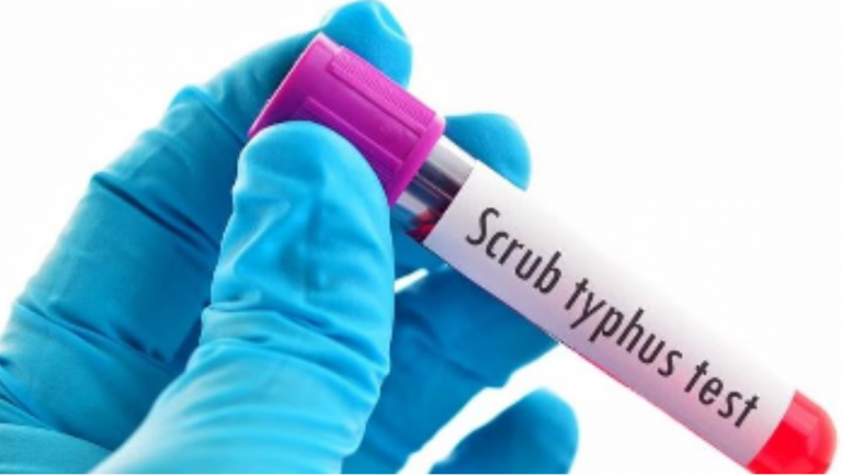 6 New Scrub Typhus Cases Detected In Odisha’s Sundargarh; Tally Mounts To 361