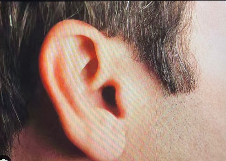 Woman Bites Off Husband’s Ear In A Fit Of Rage