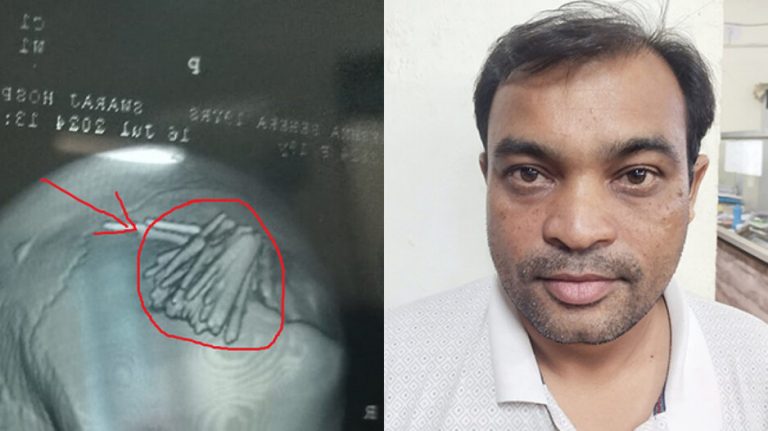 ‘Tantrik’ Held For Piercing Over 2 Dozen Needles In Girl’s Head In Odisha’s Balangir