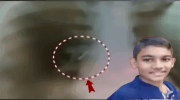 Class 7 Student Dies 10 Days After Swallowing Pin In Odisha, Parents Blame School