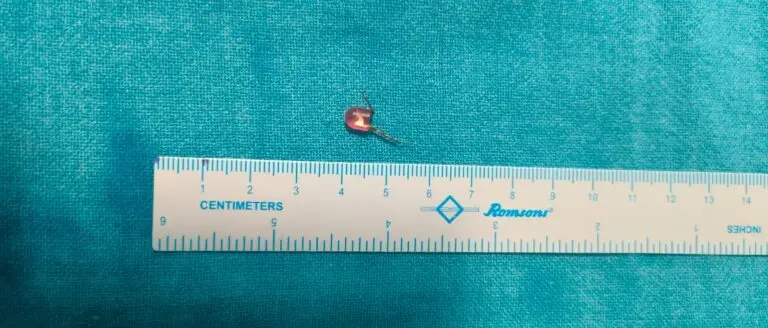 Bhubaneswar KIMS Doctors Extract Razor-Sharp Toy From 10-Month-Old’s Airway