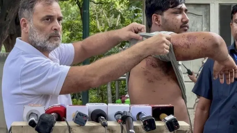Rahul Gandhi shows pellet marks
