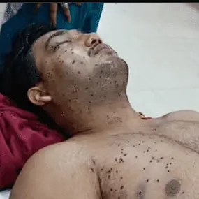RTI Response: 10 Protesters Treated For Pellet, Shot Or Projectile Injuries After 20 July Sansad Chalo March