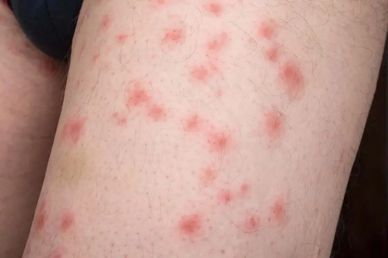 Bedbug bites
