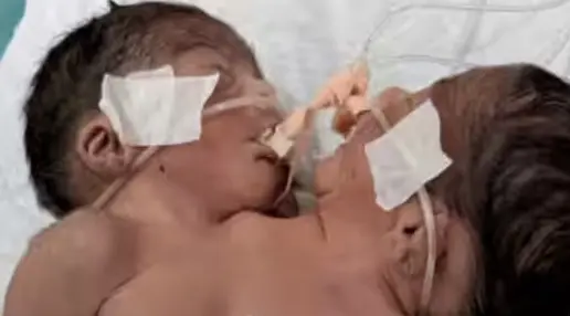 Rare Birth In Odisha Echoes Jaga-Balia Case As MKCG Docs Battle To Save Conjoined Twins